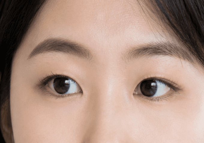 사시 발생 원인