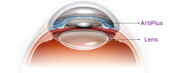 Artiplus lens implant position