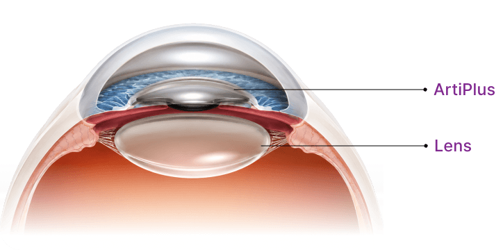 Artiplus lens implant position