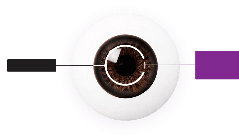 เปรียบเทียบแผลผ่าตัด SMILE (LASIK ทั่วไป 20mm vs SMILE)