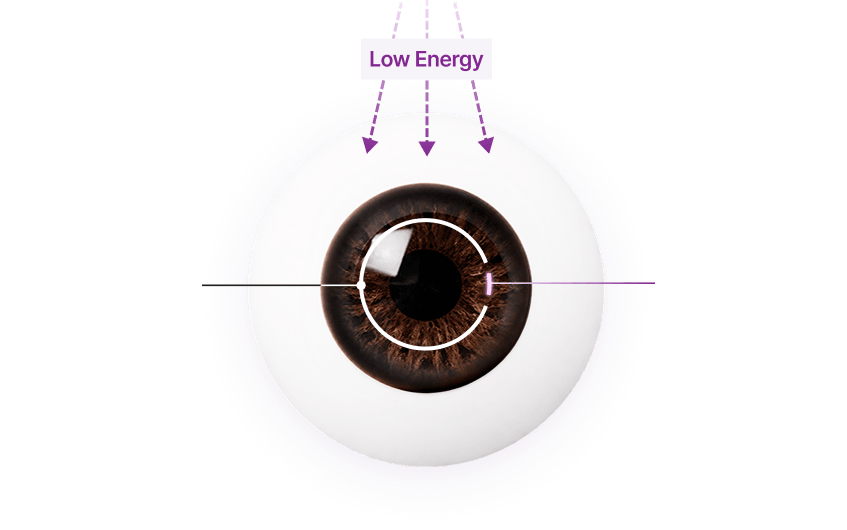 เปรียบเทียบแผล 1mm vs LASIK ทั่วไป 20mm